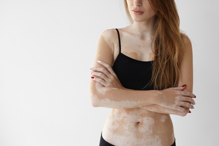 9 vitiligo Tratamiento