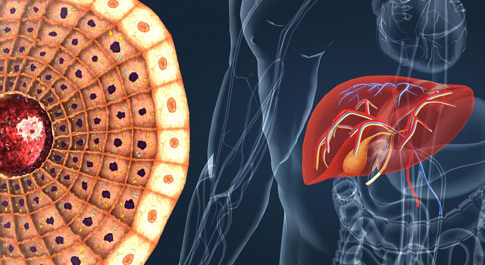 2 Consumo de alcohol y diabetes