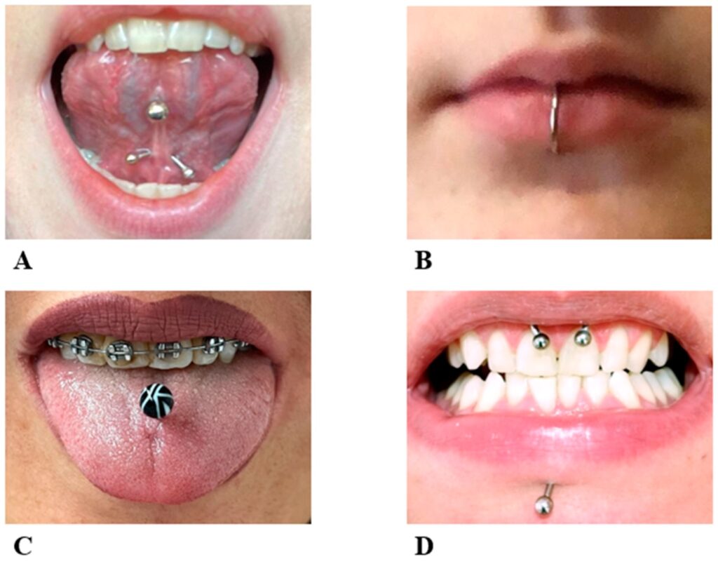 1 Complicaciones piercing