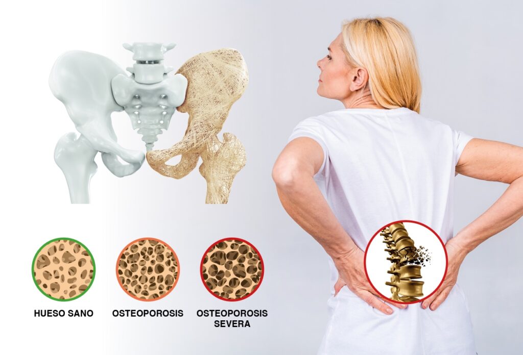 1 Osteoporosis fracturas diabetes