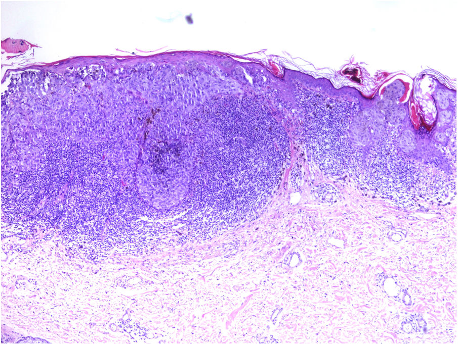 5 Melanoma cutáneo niños