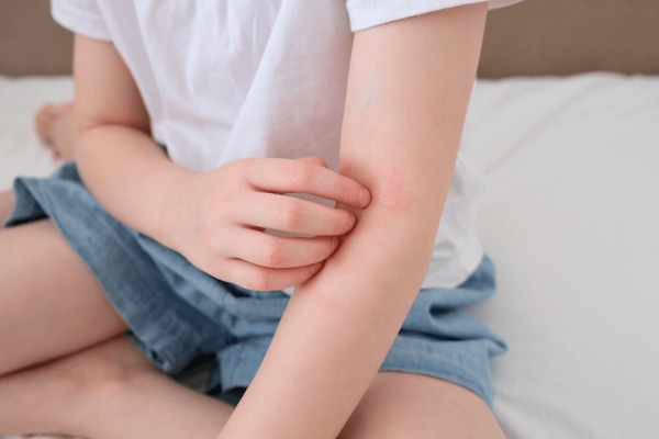 5 Psoriasis en la infancia