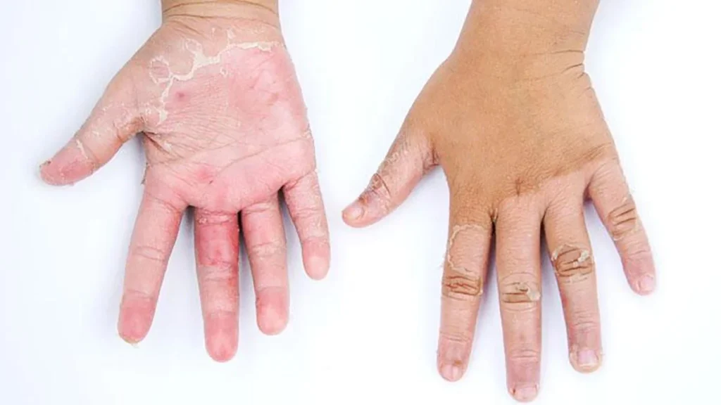 6 Psoriasis en la infancia