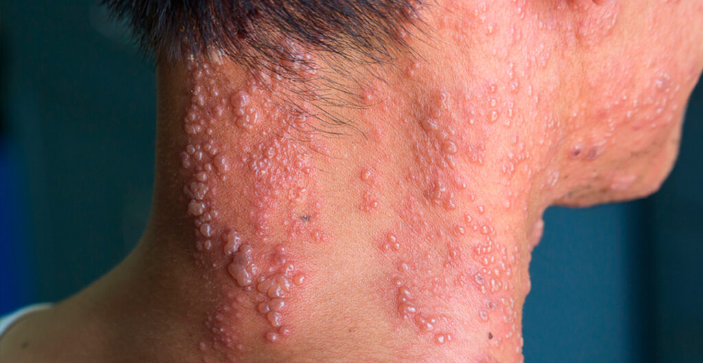 8 Herpes zoster preguntas