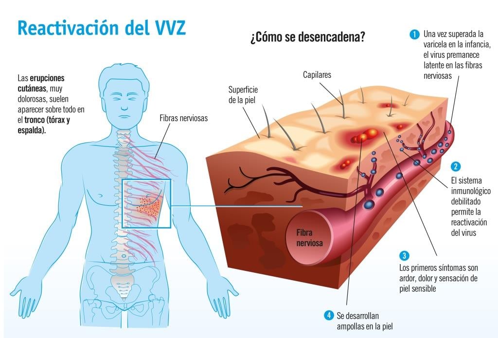 2 Herpes zóster y dermatología