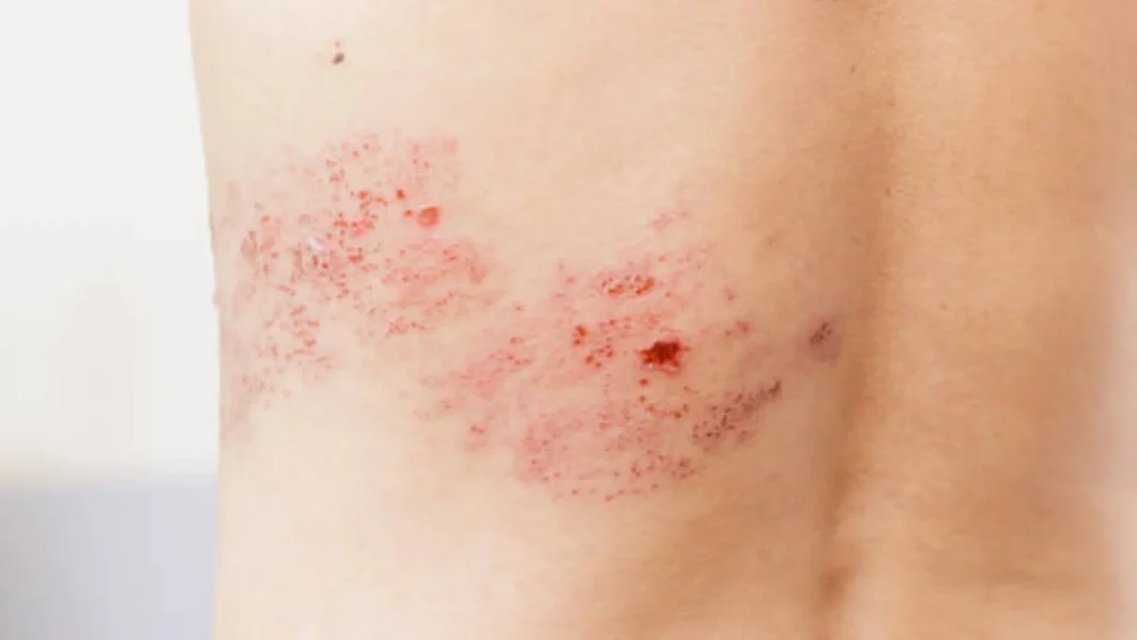 6 Herpes zóster y dermatología