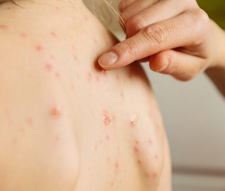 0 Herpes zóster y dermatología