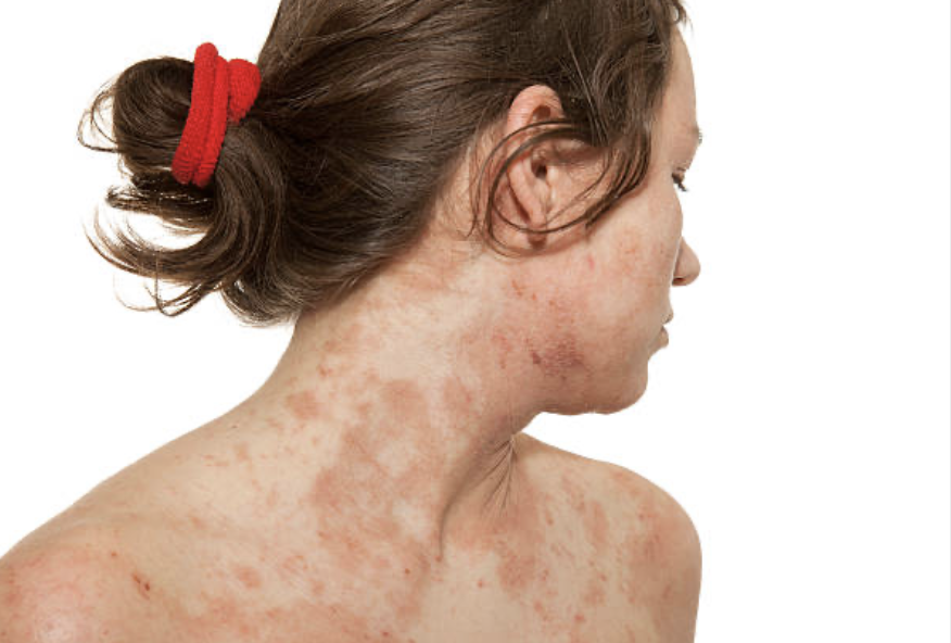 6 Dermatitis atópica diabetes