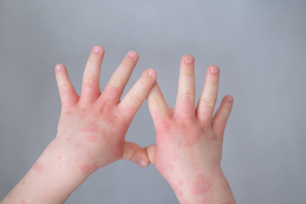 6 Dermatitis atópica niños