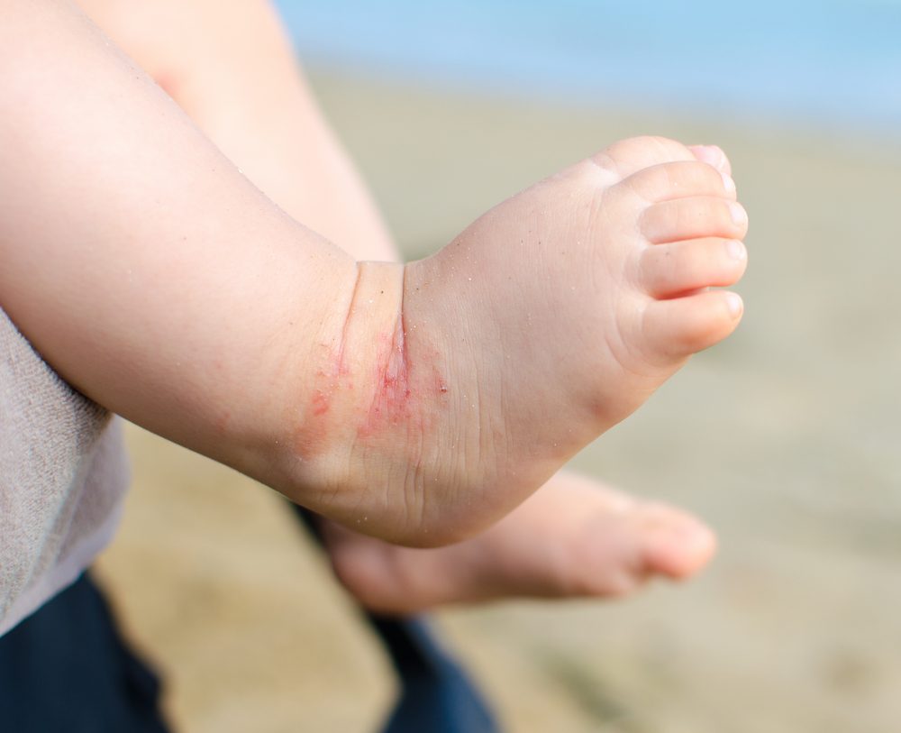 7 Dermatitis atópica niños