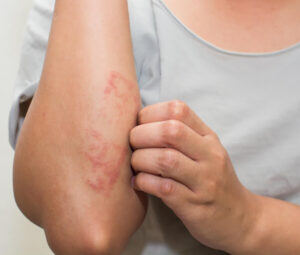 0 Dermatitis atópica diabetes