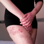 0 Diabetes lupus