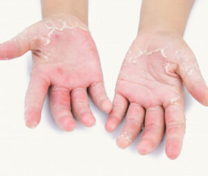 0 Psoriasis palmoplantar niños