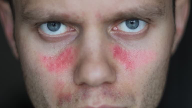 3 Diabetes lupus