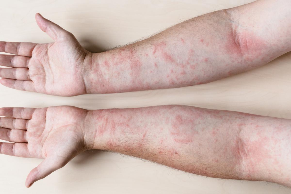 2 Diabetes lupus