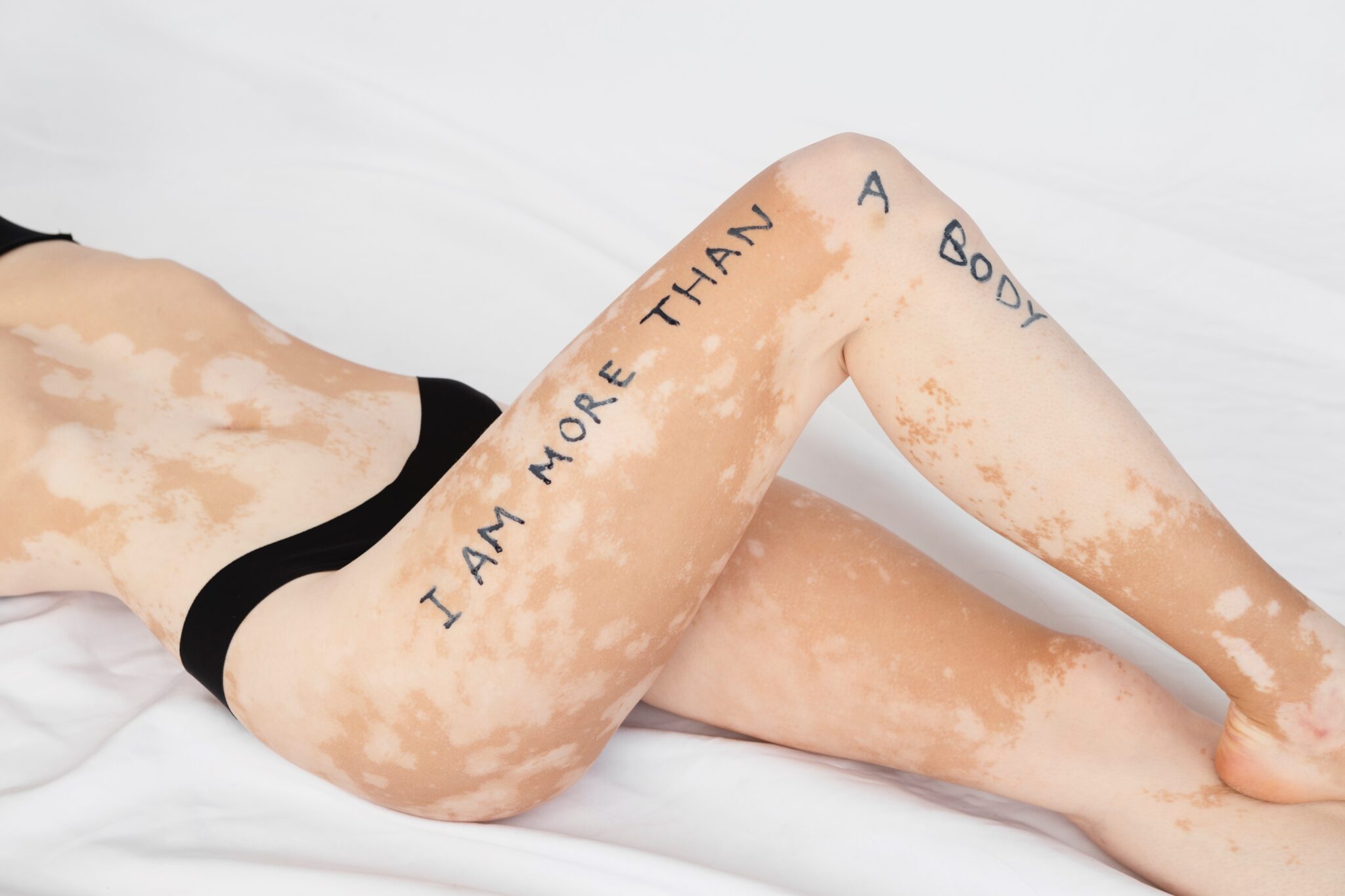 0 Día mundial vitiligo 2025