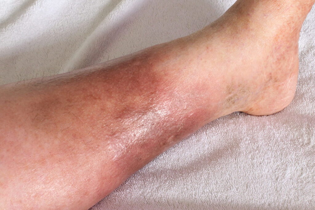 1 Obesidad celulitis