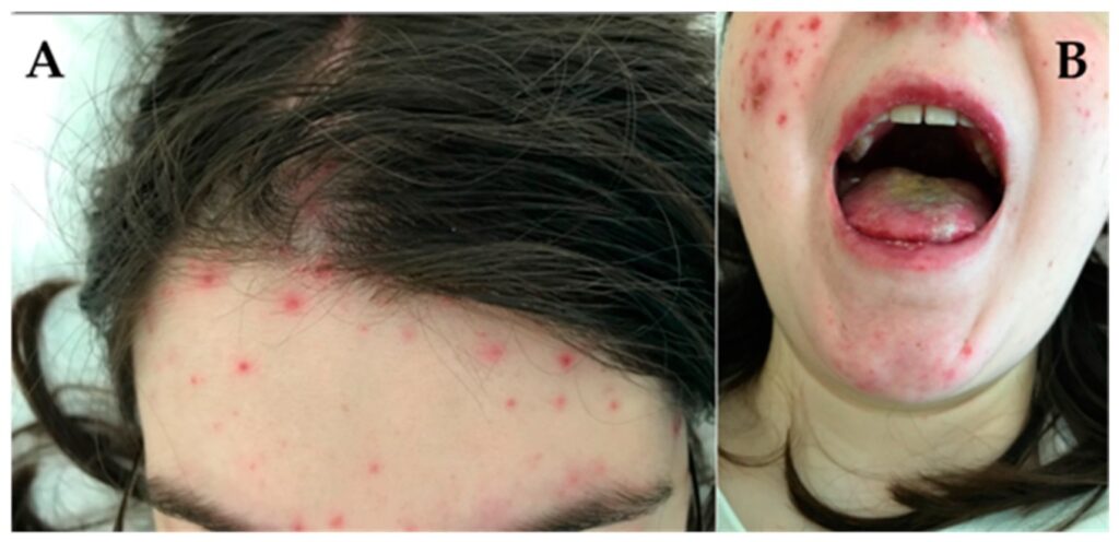 2 Lupus eritematoso