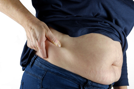 2 Obesidad celulitis