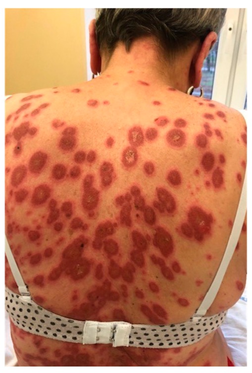 3 Lupus eritematoso