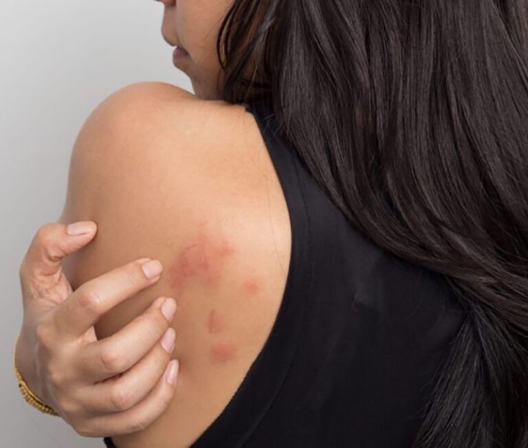 33-Urticaria-cronica-espontanea-1