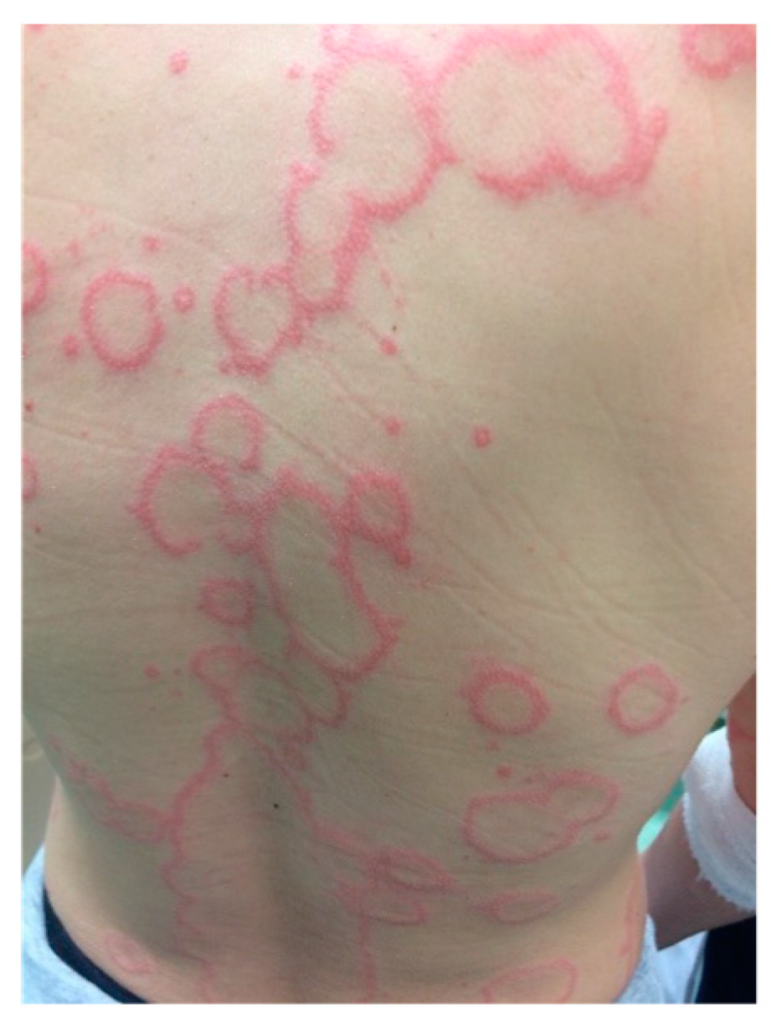 4 Lupus eritematoso
