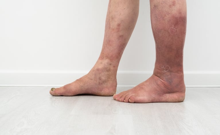 4 Obesidad celulitis