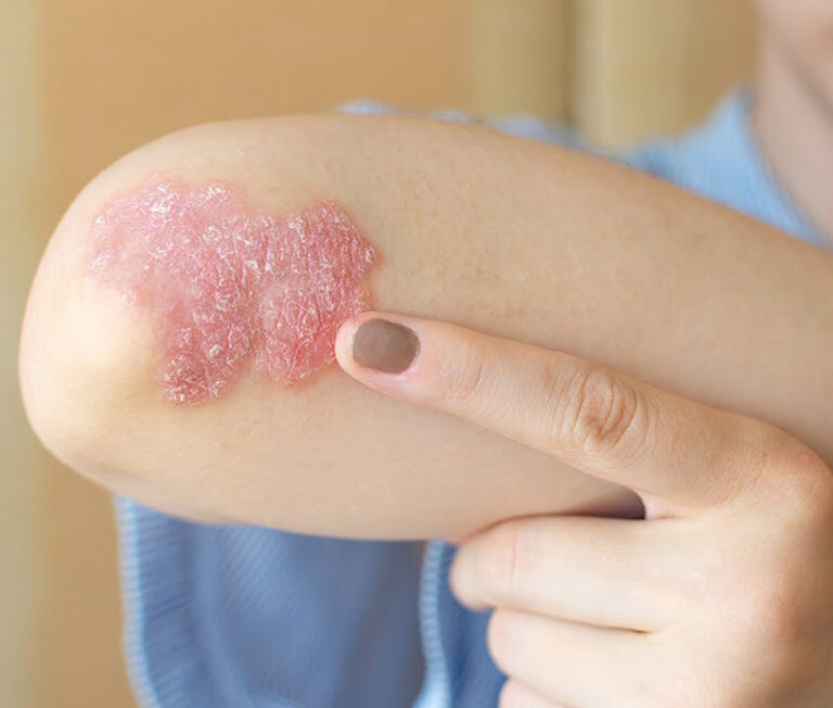 5 Psoriasis y diabetes