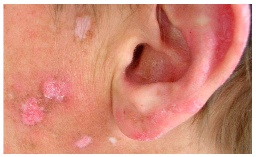 5 Lupus eritematoso