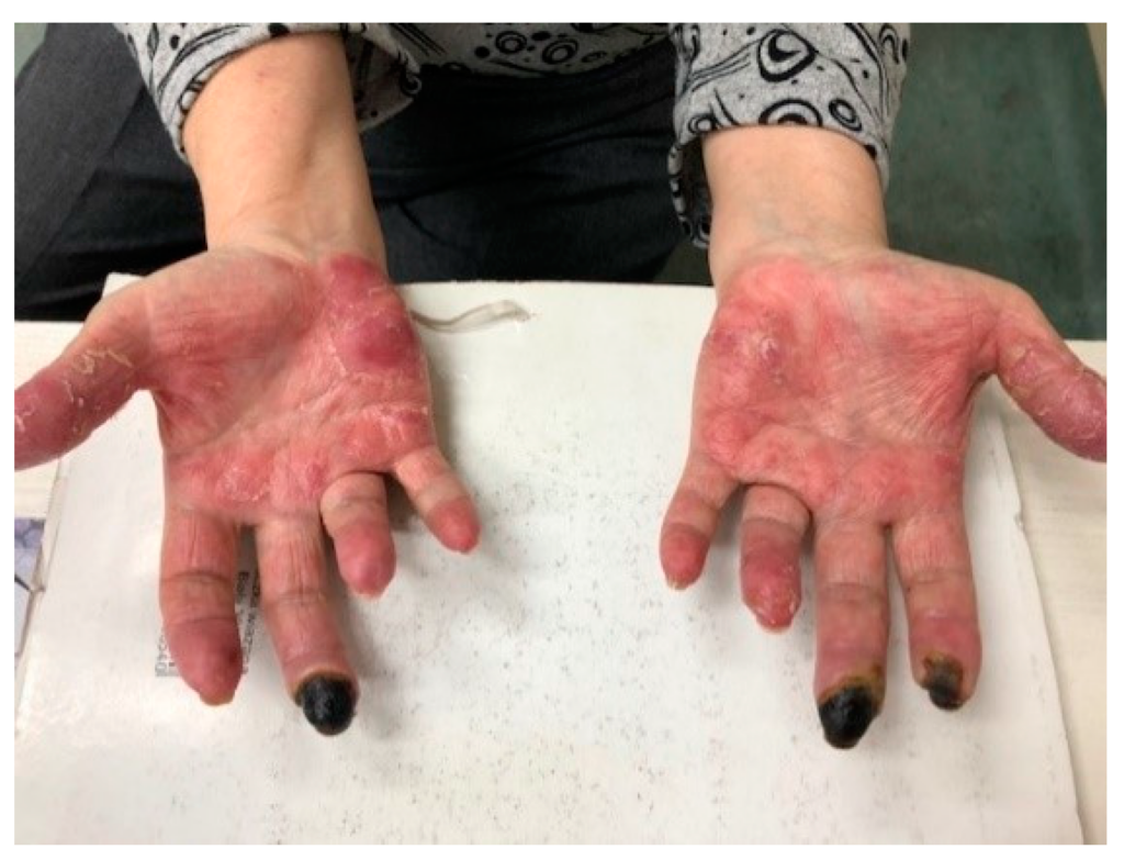 6 Lupus eritematoso