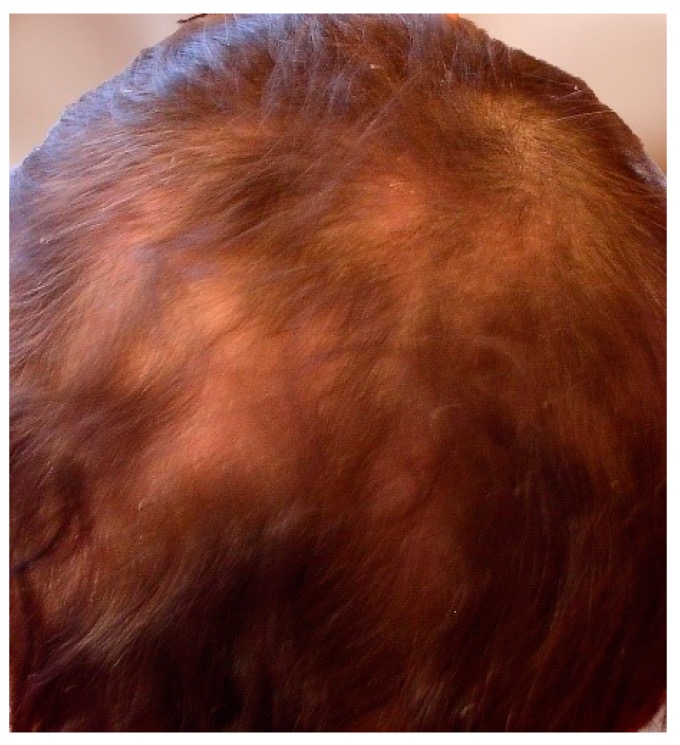 7 Lupus eritematoso