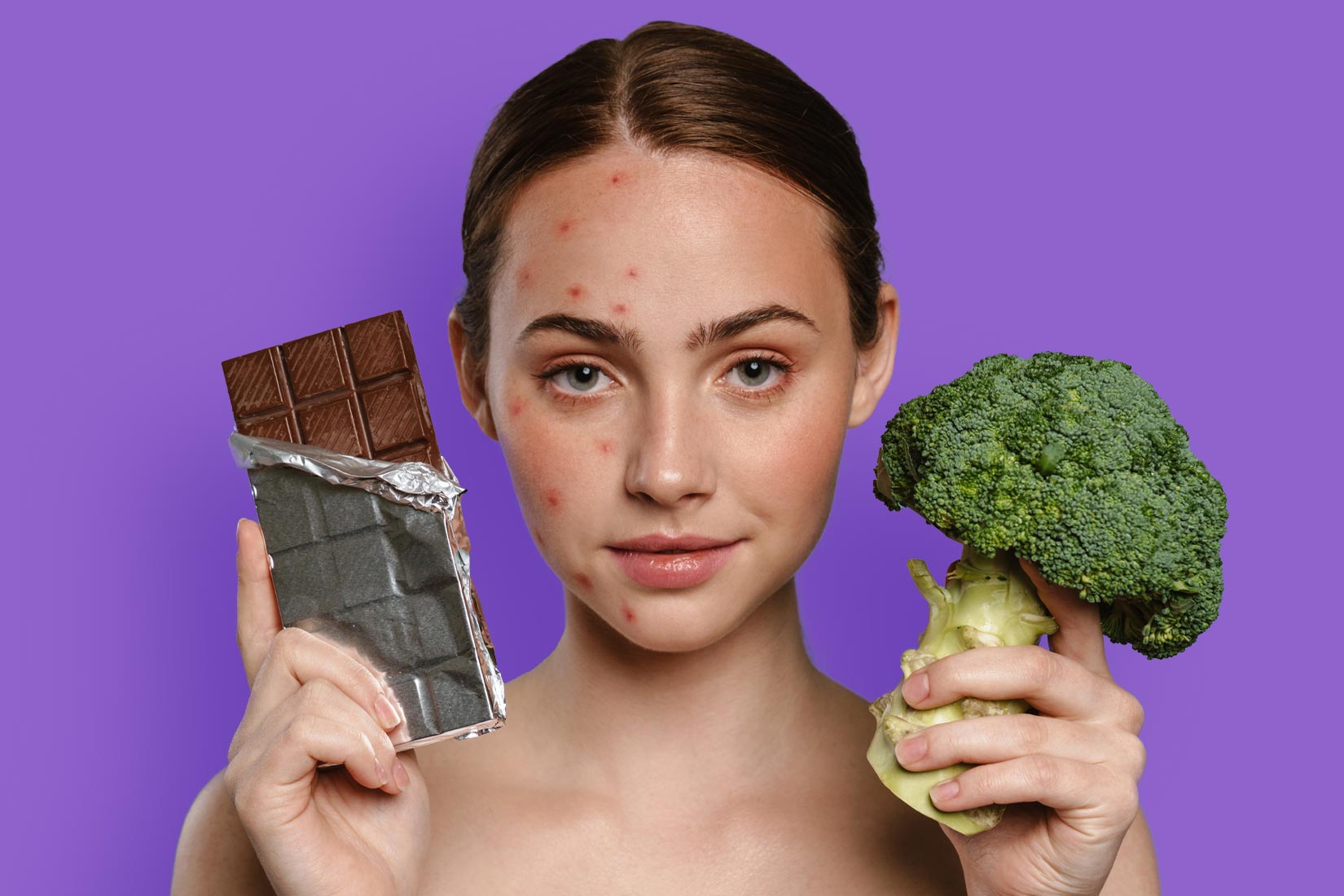 0 Acné nutrición
