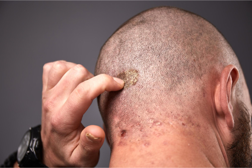 0 Dermatitis seborreica tratamiento