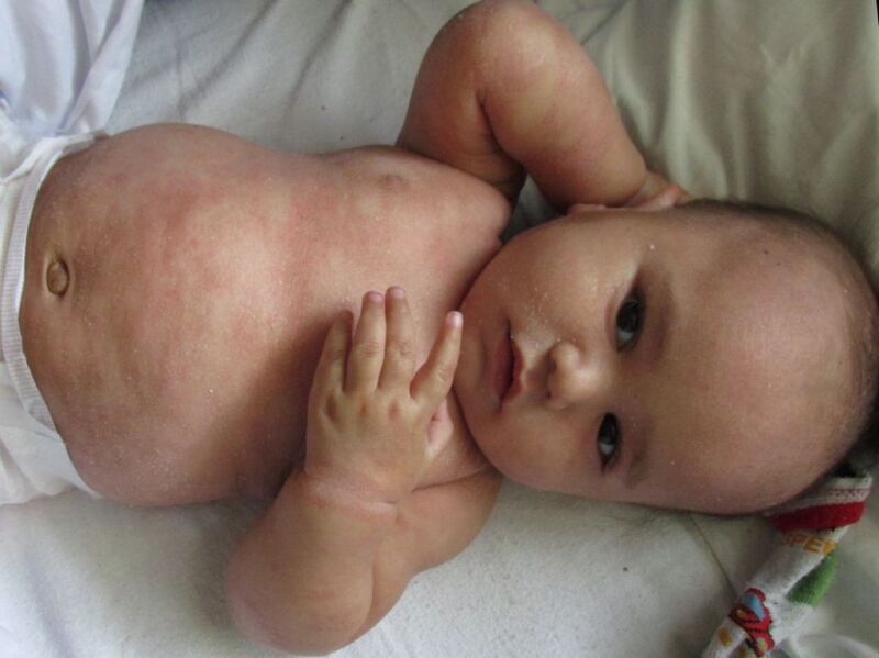 1 Dermatitis seborreica tratamiento