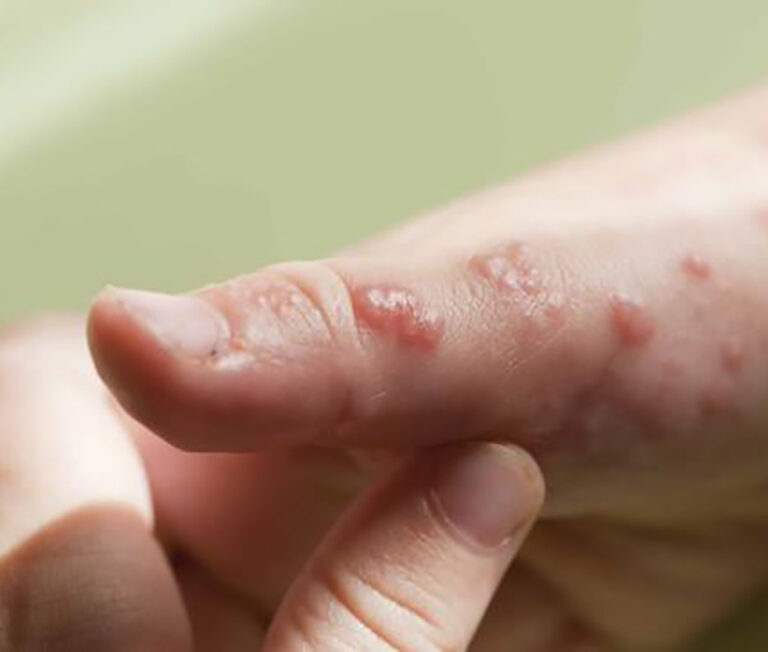 1 Piel de cristal tratamientos