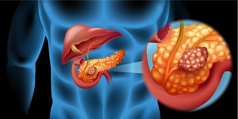 1 diabetes páncreas islotes