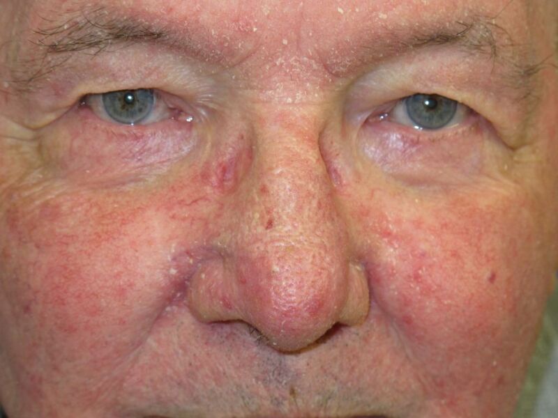 2 Dermatitis seborreica tratamiento