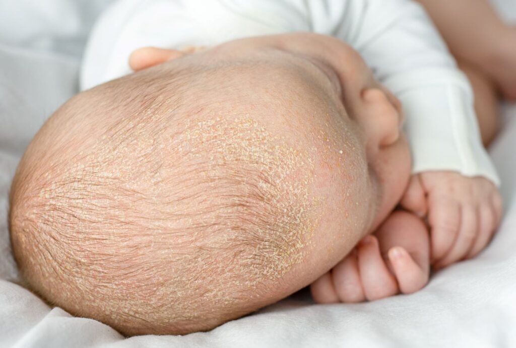 2 Dermatitis seborreica y dieta