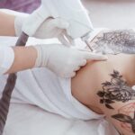 22 Eliminación tatuajes