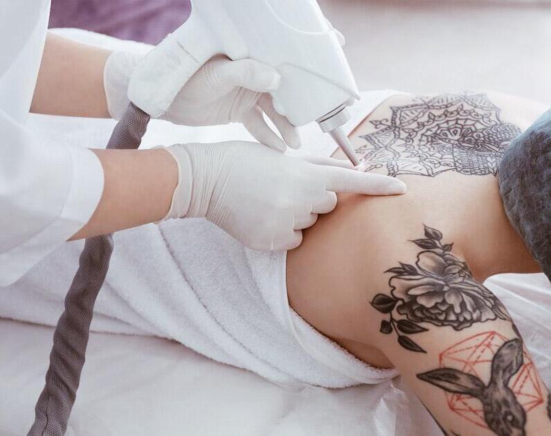 22 Eliminación tatuajes