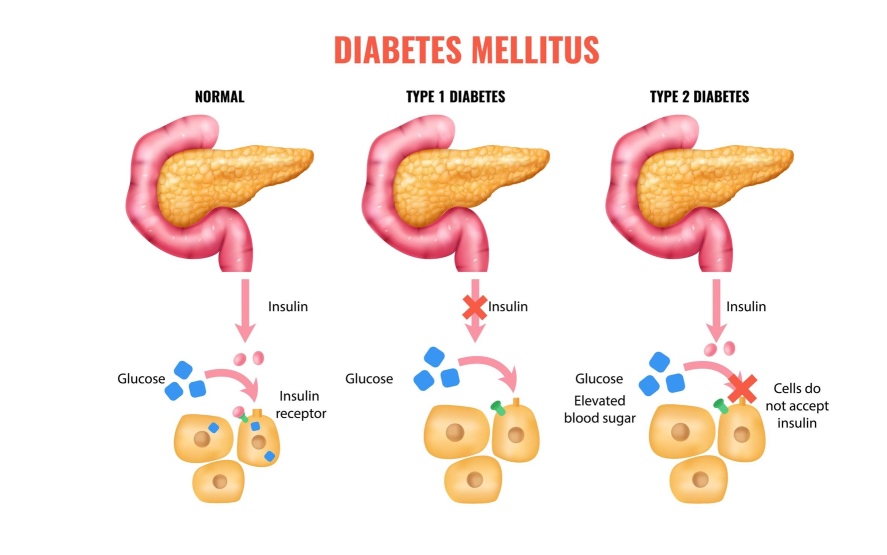 2 diabetes páncreas islotes