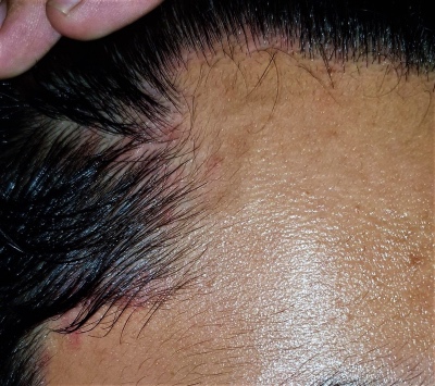 3 Dermatitis seborreica tratamiento