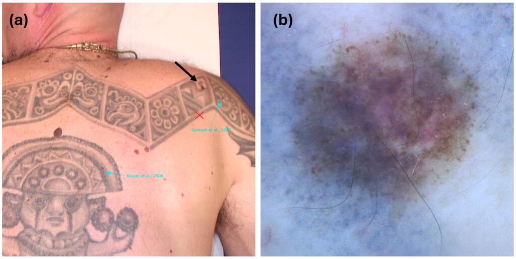 3 Tatuajes melanoma
