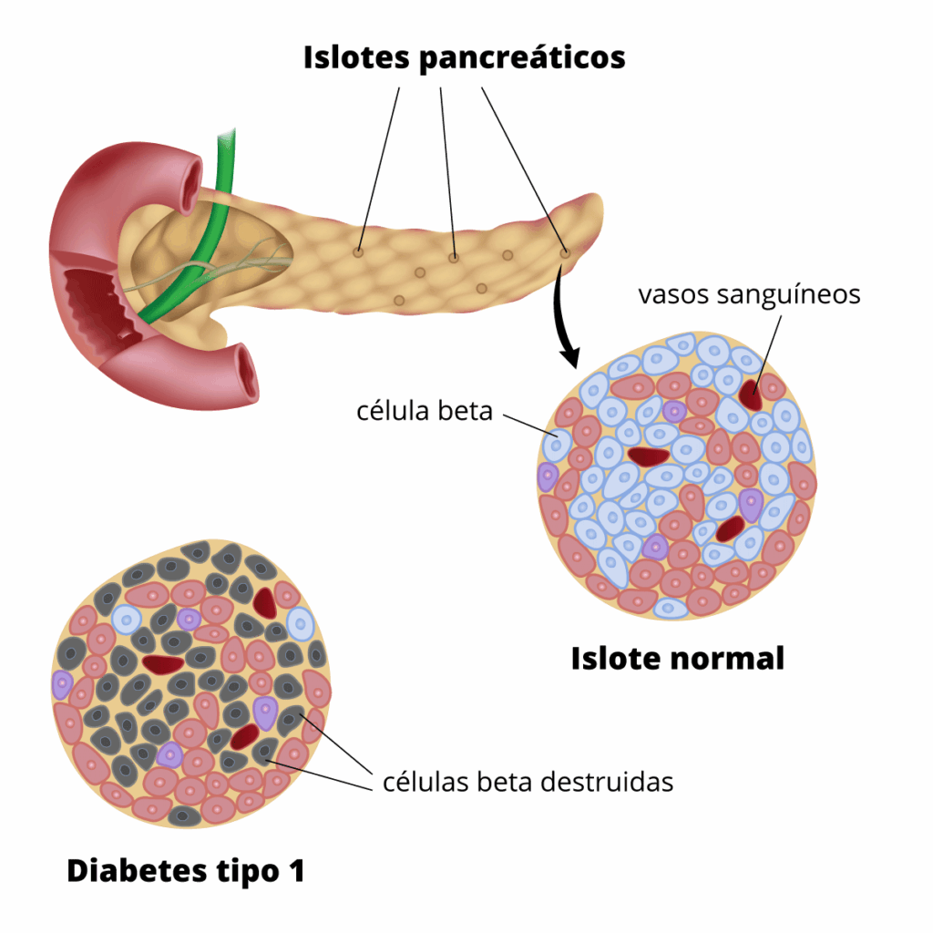 3 diabetes páncreas islotes
