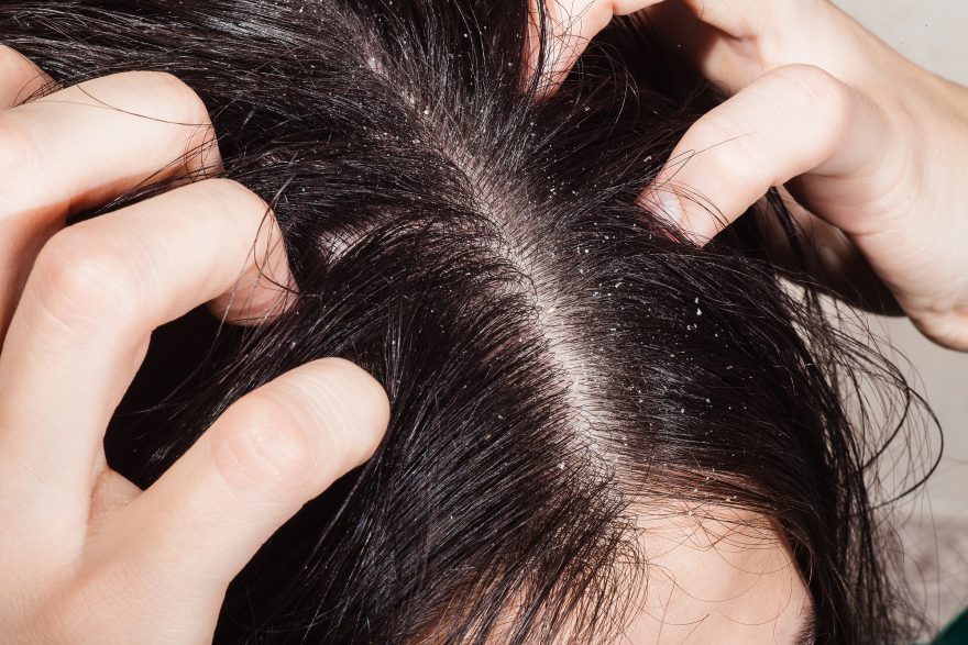 4 Dermatitis seborreica síntomas