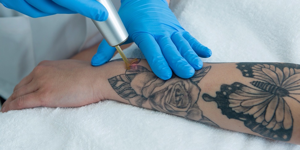 5 Eliminación tatuajes