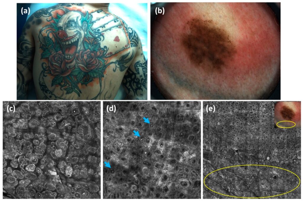 6 Tatuajes melanoma