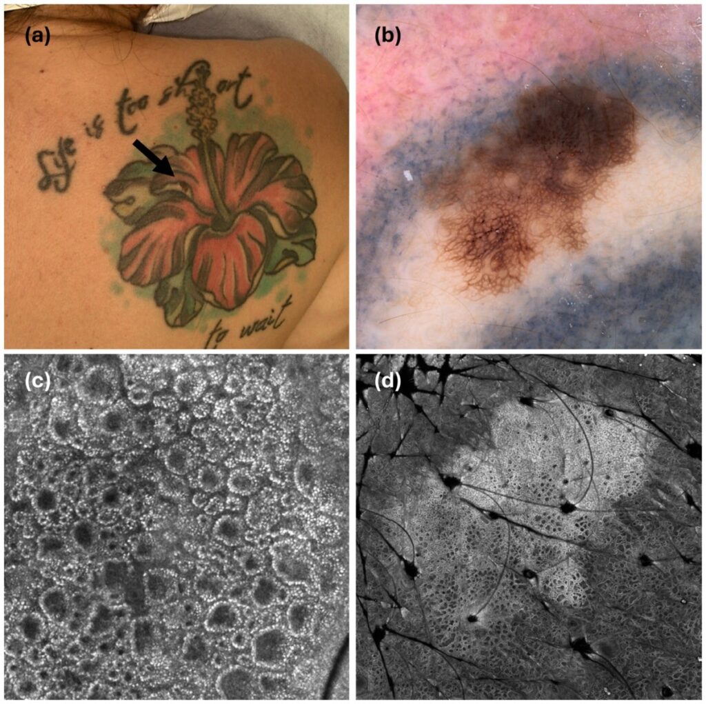 7 Tatuajes melanoma