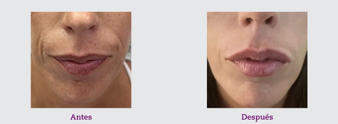7 ácido hialurónico labios