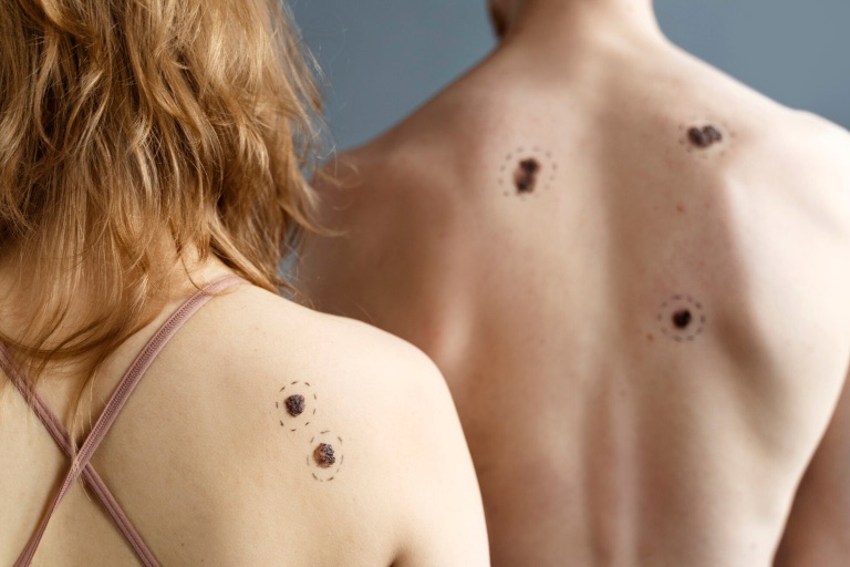 00 Melanoma cutáneo primario